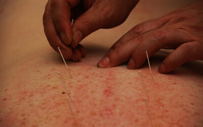 Acupuncture as an infertility treatment?